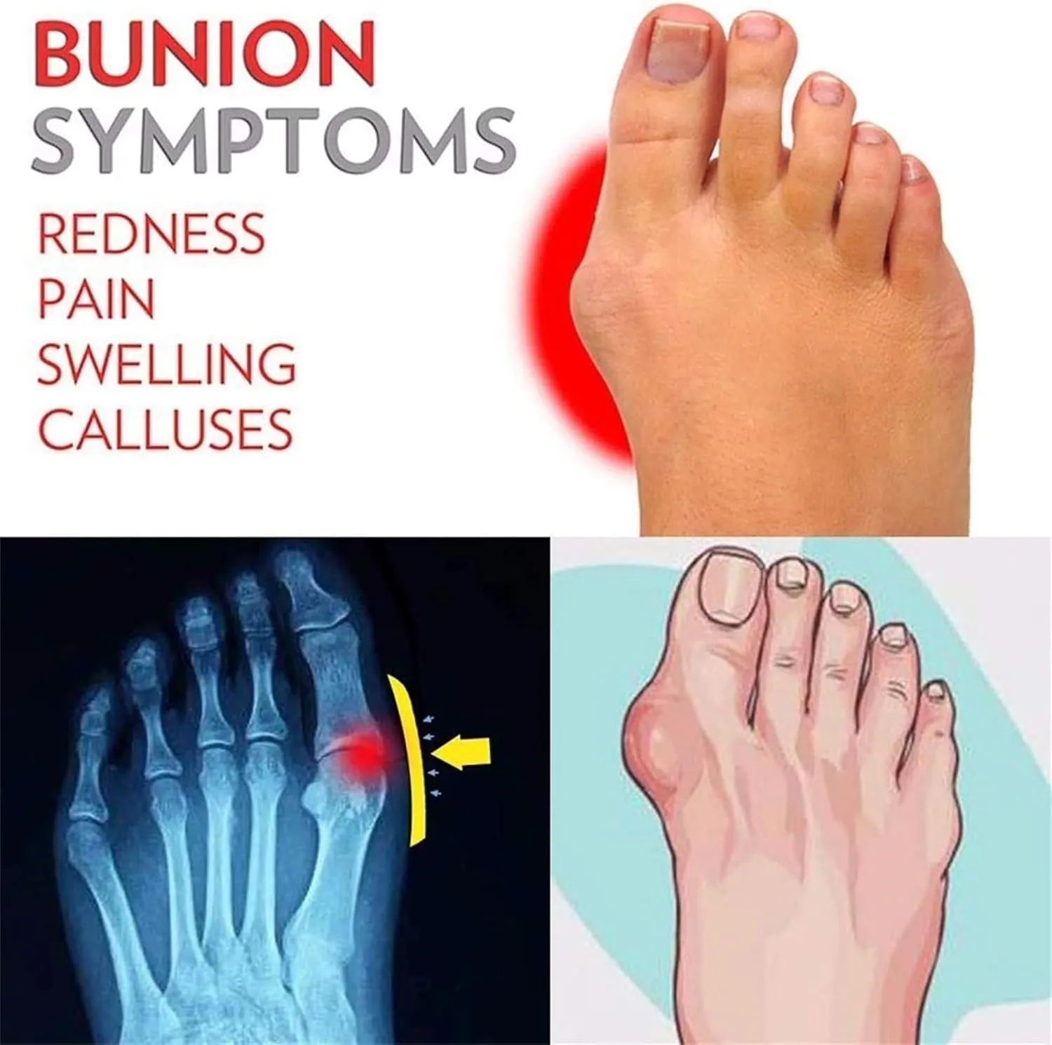 Women Mules Orthopedic Sandals, Women's Square Toe Slip on Flat Wide Bunion Orthopedic Sandals, Breathable Casual Beach Travel, for Big Toe Bone Correction Toe Arch Support